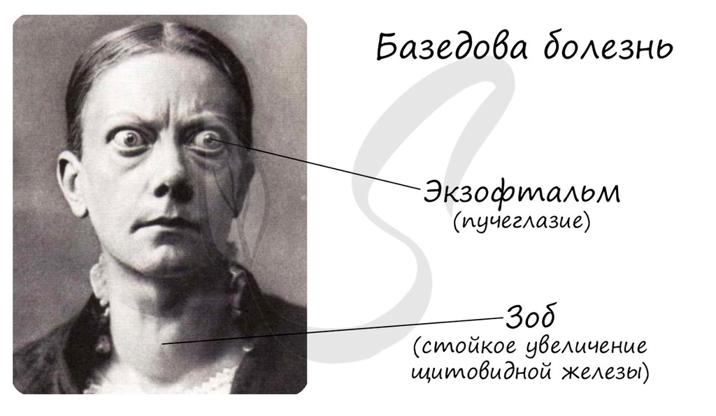 Слайд 22 «Гиперфункция щитовидной - базедова болезнь. Увеличивается уровень обмена веществ, повышается температура, экзофтальм , зоб.» — иллюстрация к презентации «Гуморальная регуляция и эндокринная система» по биологии для 11 класса