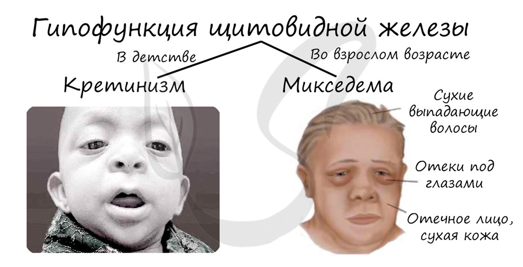 Слайд 21 — иллюстрация к презентации «Гуморальная регуляция и эндокринная система» по биологии для 11 класса
